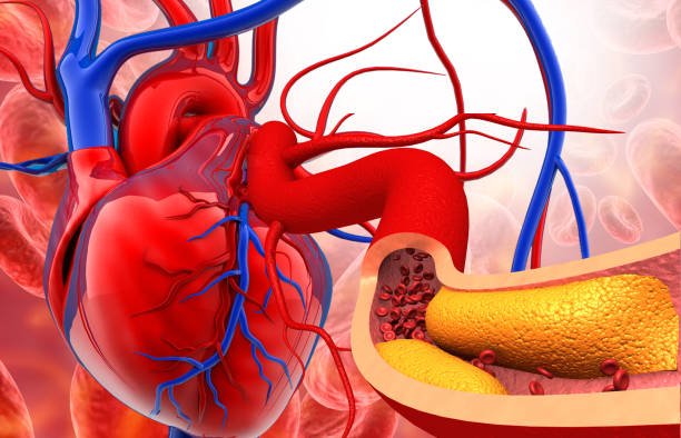 Understanding Heart Blockages and the Role of Medical Therapy