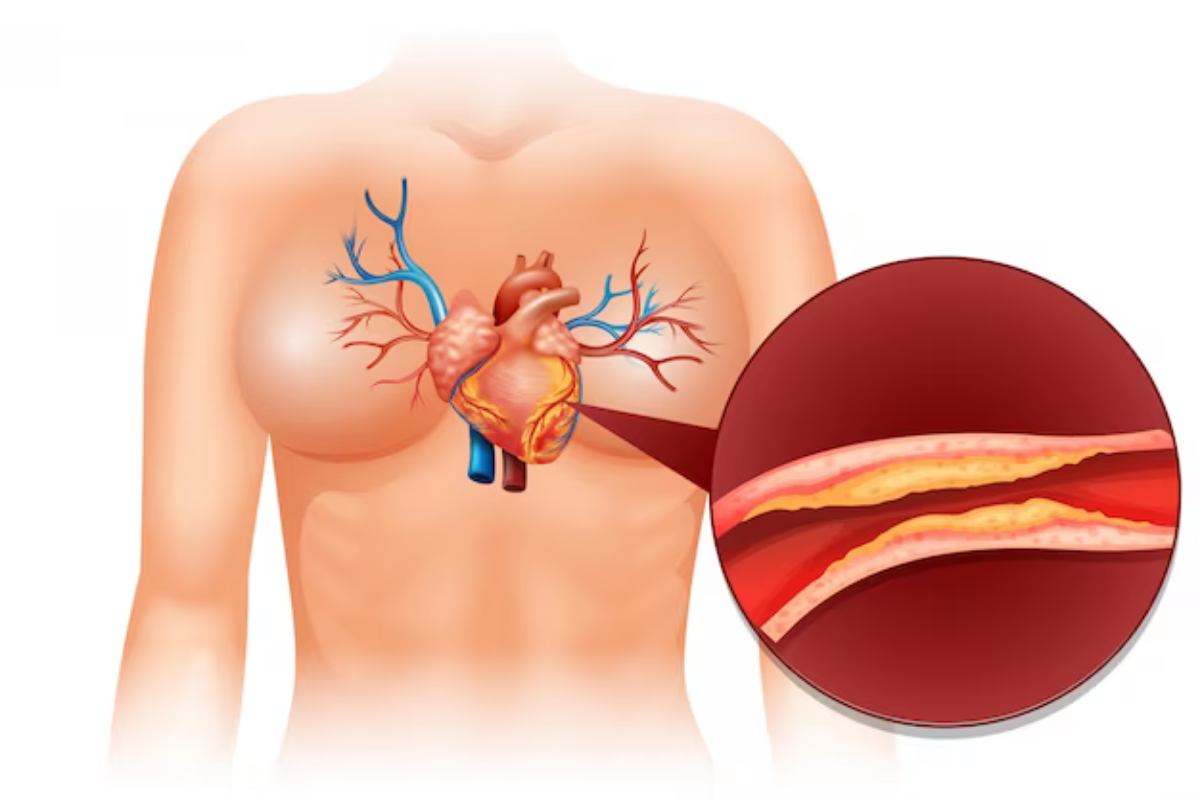 Angioplasty