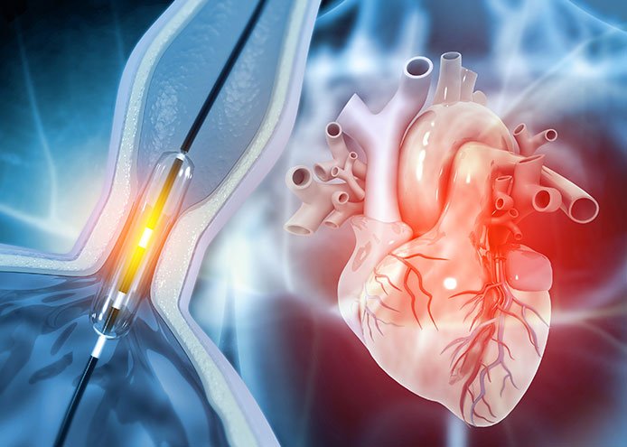 Understanding Angioplasty